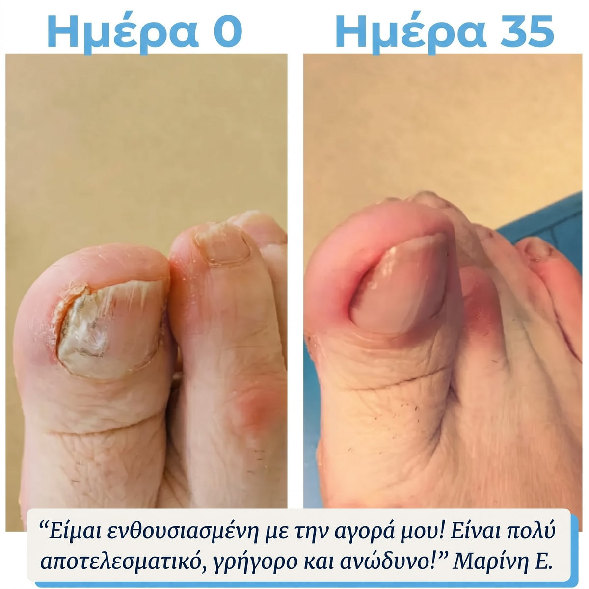 NailCare Pro - ημέρα 0 και ημέρα 35